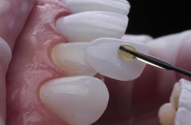 DÁN SỨ VENEER